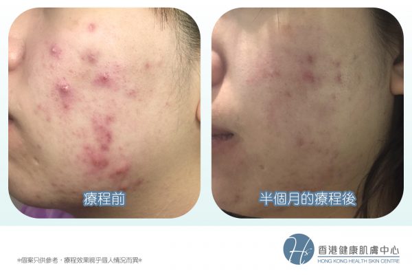 3個月擺脫纏擾10年的暗瘡問題│香港健康肌膚中心 - ATP再生體驗