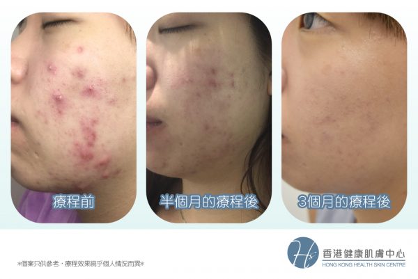 3個月擺脫纏擾10年的暗瘡問題│香港健康肌膚中心 - ATP再生體驗